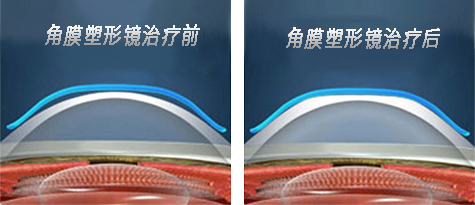 角膜塑形镜治疗